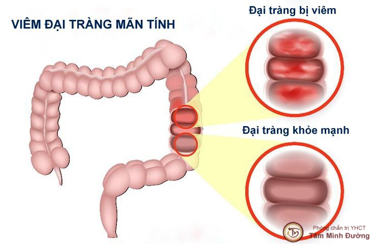 Ban-Than-Cua-Vi-Khuan-Duong-Ruot-Tinh-Bot-Khang-Tu-Nhien-Dr-Ruot-5